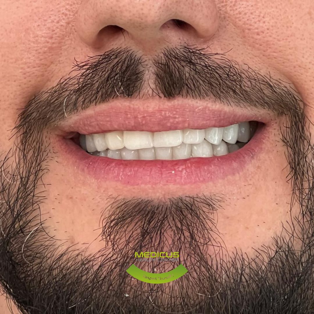 Smile Makeover