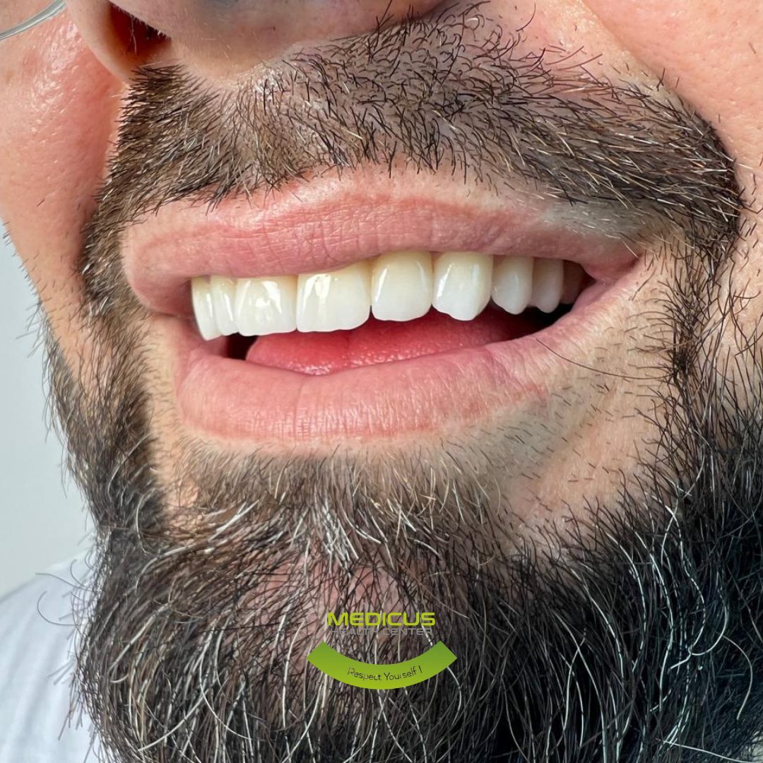 Veneers